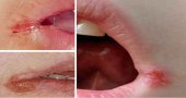Что делать, если в уголках губ появились трещины?