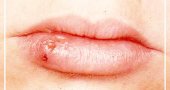 Герпес на губах: лечение