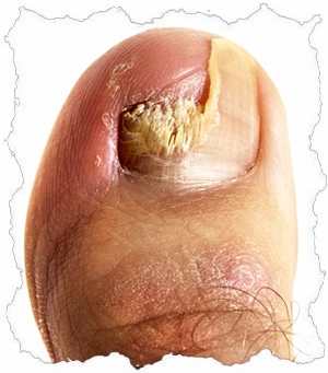 Грибковая инфекция ногтя